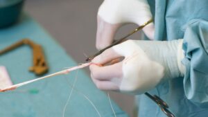 Complicazioni post chirurgiche dell'intervento di ricostruzione del legamento crociato anteriore