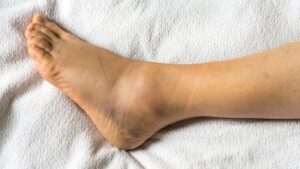 Ankle Sprain e Outcome funzionali per il return to play