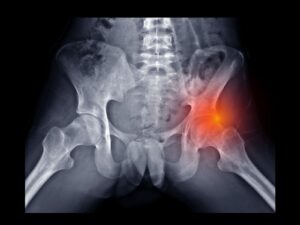 Impingement femoro-acetabolare: inquadramento diagnostico