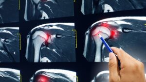 Lesione massiva di cuffia: fisioterapia si!