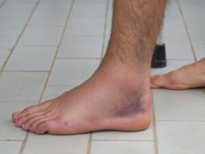 Distorsione laterale di caviglia