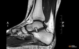 Traumi distorsivi e lesioni legamentose croniche della caviglia: la prospettiva dell'ortopedico