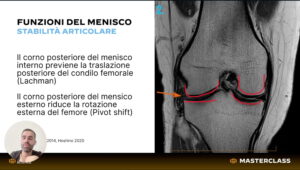 Lesioni Meniscali