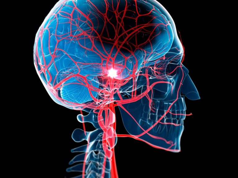 Cervical Artery Dissection (CAD)
