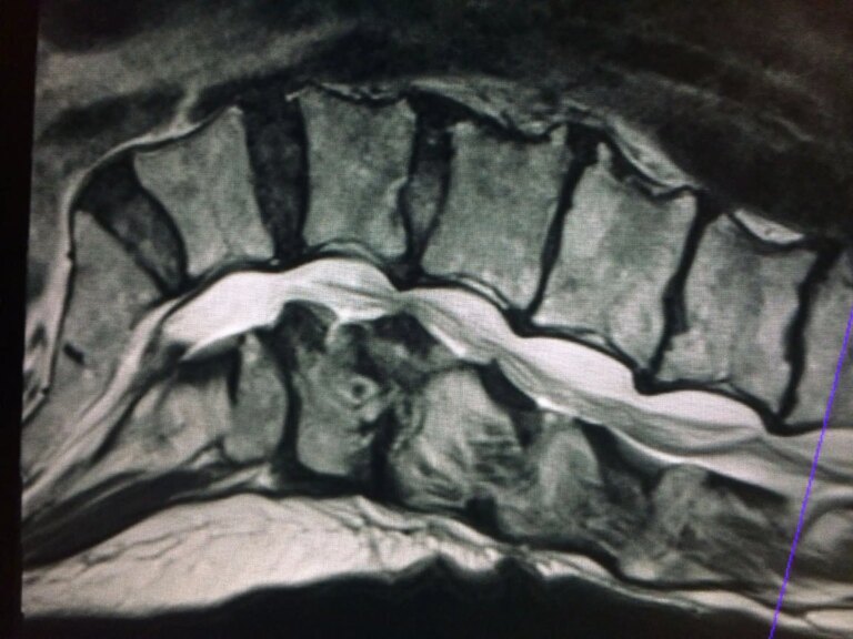Stenosi Spinale Lombare