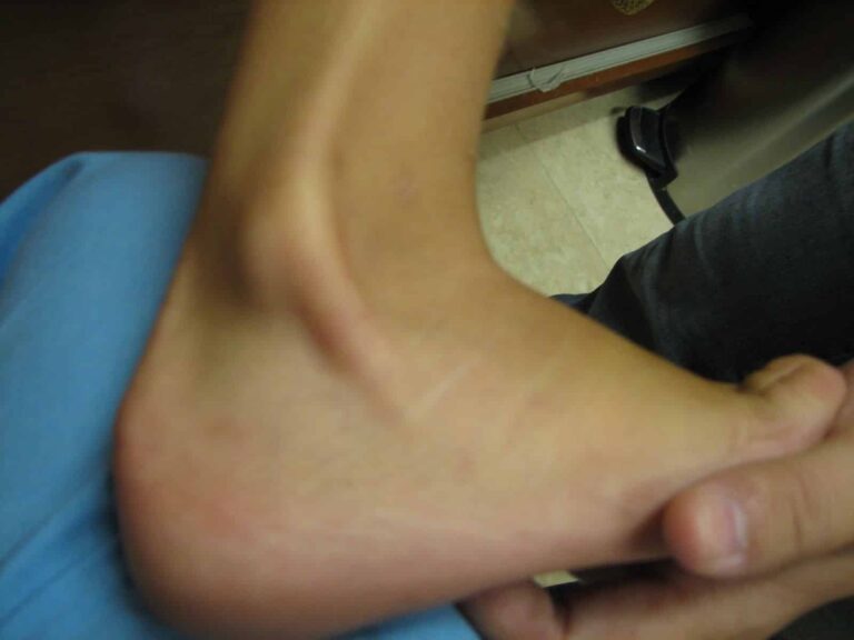 Sublussazione tendini peronei