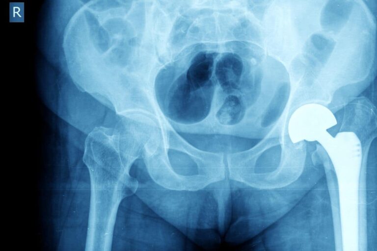 copertina protesi d'anca