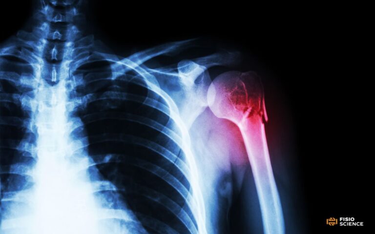 fratture omero cover