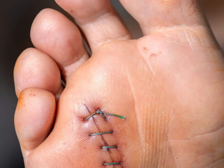 Neuroma di Morton