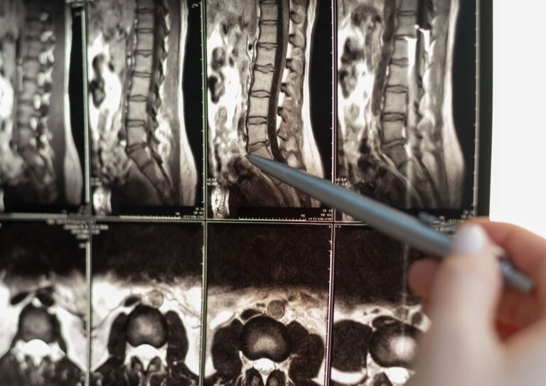 sindrome cauda equina