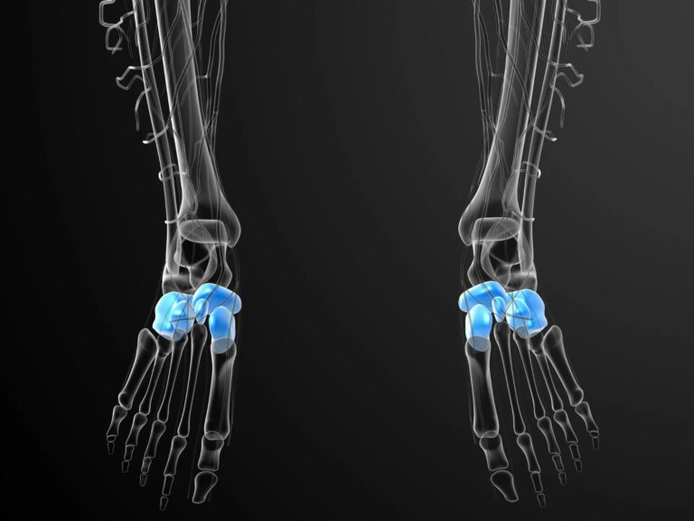 sindrome del cuboide