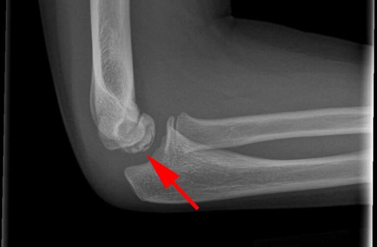 sindrome di panner cover