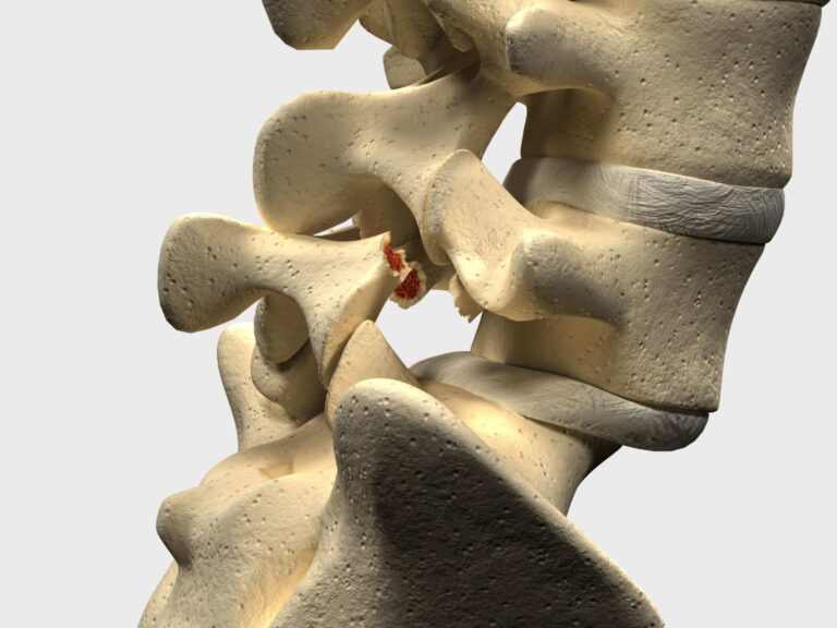 spondilolistesi fisioscience