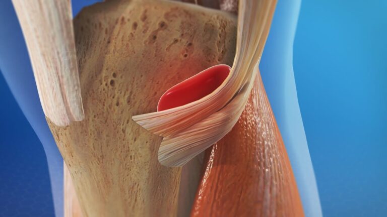 tendinopatia zampa d'oca